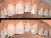 Appearance Capture and Modeling of Human Teeth